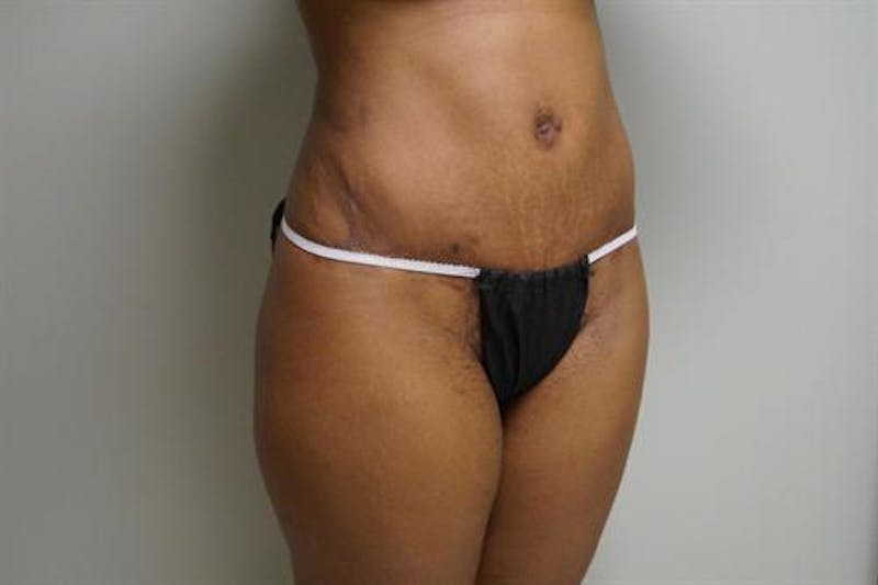 Tummy Tuck Before & After Gallery - Patient 233394 - Image 4