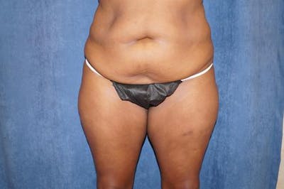 Tummy Tuck Before & After Gallery - Patient 143428 - Image 1