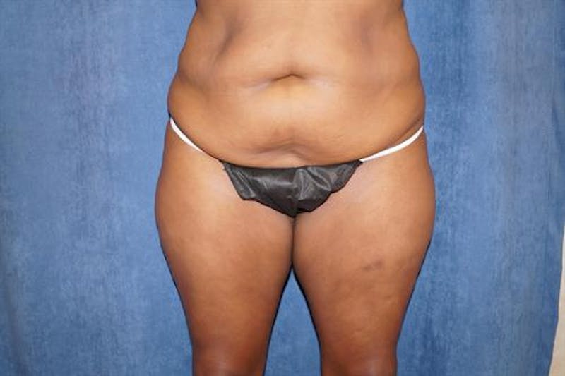 Tummy Tuck Before & After Gallery - Patient 143428 - Image 1