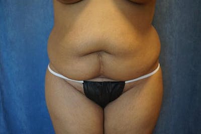 Tummy Tuck Before & After Gallery - Patient 256224 - Image 1