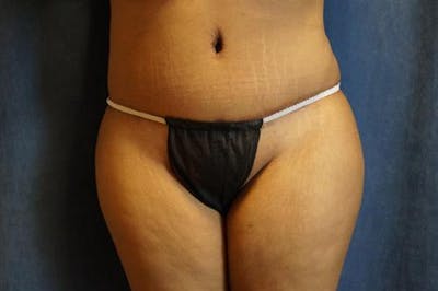 Tummy Tuck Before & After Gallery - Patient 256224 - Image 2