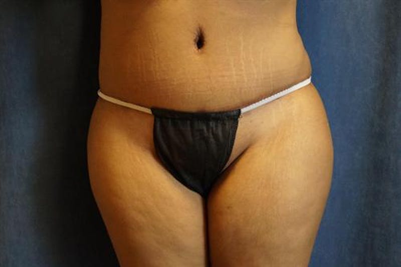Tummy Tuck Before & After Gallery - Patient 256224 - Image 2