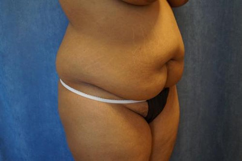 Tummy Tuck Before & After Gallery - Patient 256224 - Image 3