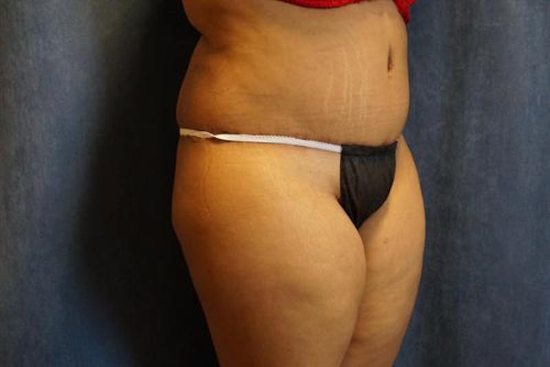 Tummy Tuck Before & After Gallery - Patient 256224 - Image 4