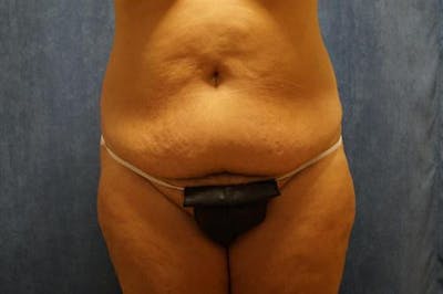Tummy Tuck Before & After Gallery - Patient 322937 - Image 1
