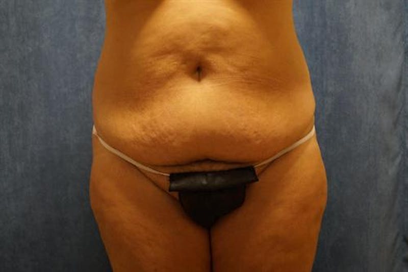 Tummy Tuck Before & After Gallery - Patient 322937 - Image 1