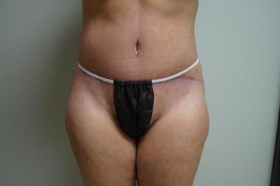 Tummy Tuck Before & After Gallery - Patient 322937 - Image 2