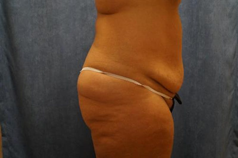 Tummy Tuck Before & After Gallery - Patient 322937 - Image 3