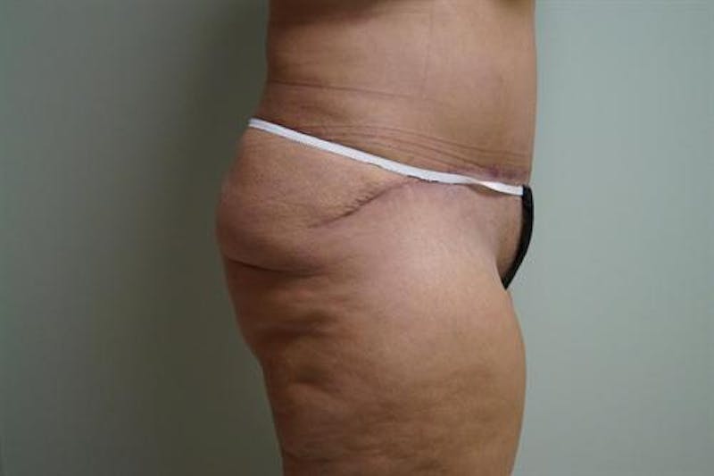 Tummy Tuck Before & After Gallery - Patient 322937 - Image 4