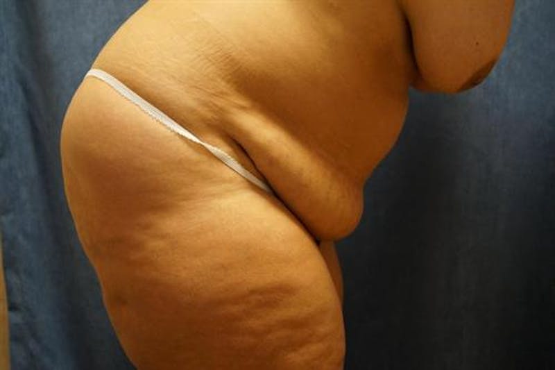 Tummy Tuck Before & After Gallery - Patient 322937 - Image 5