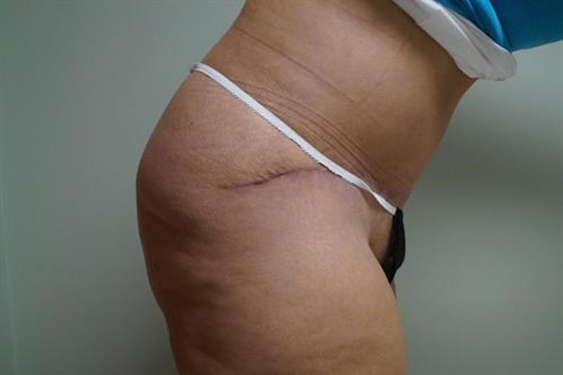 Tummy Tuck Before & After Gallery - Patient 322937 - Image 6