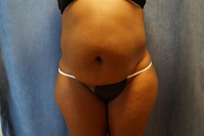 Tummy Tuck Before & After Gallery - Patient 370160 - Image 1