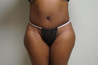 Tummy Tuck Before & After Gallery - Patient 370160 - Image 2