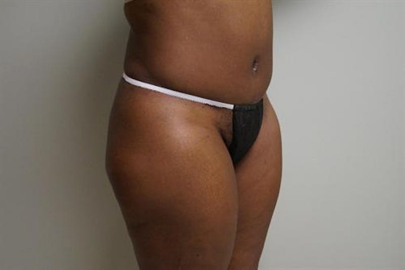 Tummy Tuck Before & After Gallery - Patient 370160 - Image 4