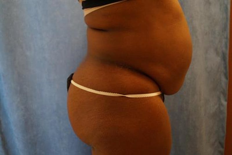 Tummy Tuck Before & After Gallery - Patient 370160 - Image 5