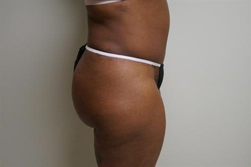 Tummy Tuck Before & After Gallery - Patient 370160 - Image 6