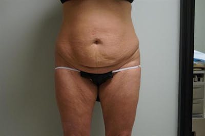 Tummy Tuck Before & After Gallery - Patient 333950 - Image 1