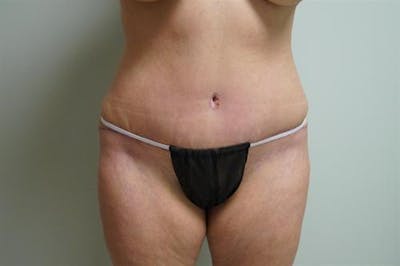 Tummy Tuck Before & After Gallery - Patient 333950 - Image 2
