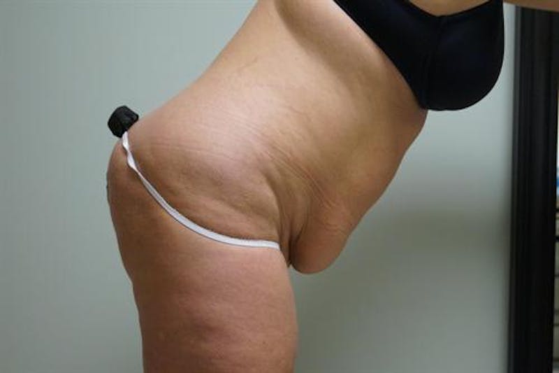 Tummy Tuck Before & After Gallery - Patient 333950 - Image 3