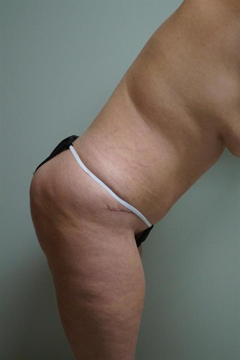 Tummy Tuck Before & After Gallery - Patient 333950 - Image 4