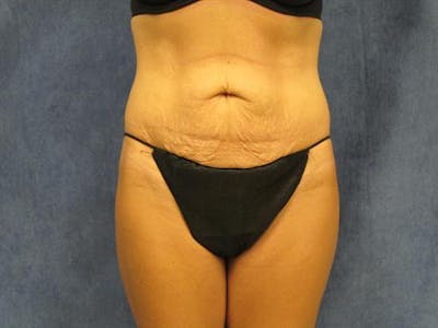 Tummy Tuck Before & After Gallery - Patient 105671 - Image 1