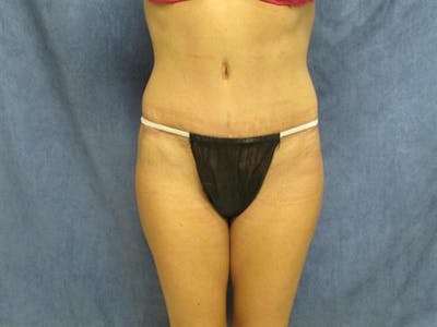 Tummy Tuck Before & After Gallery - Patient 105671 - Image 2