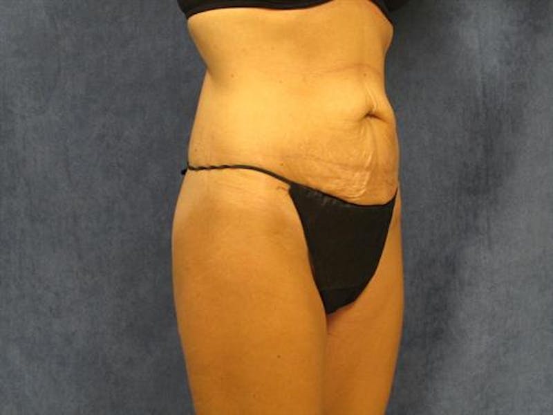 Tummy Tuck Before & After Gallery - Patient 105671 - Image 3