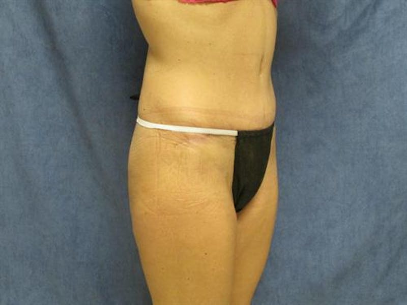 Tummy Tuck Before & After Gallery - Patient 105671 - Image 4