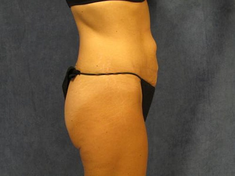 Tummy Tuck Before & After Gallery - Patient 105671 - Image 5
