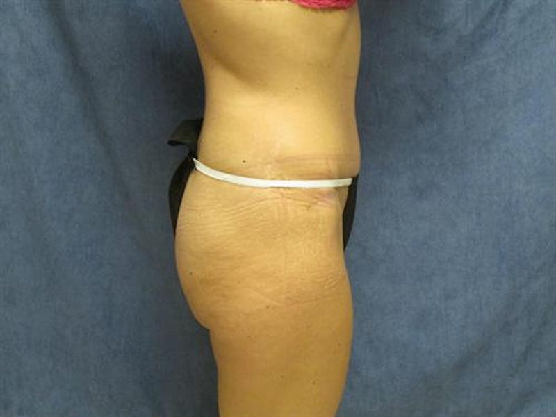 Tummy Tuck Before & After Gallery - Patient 105671 - Image 6