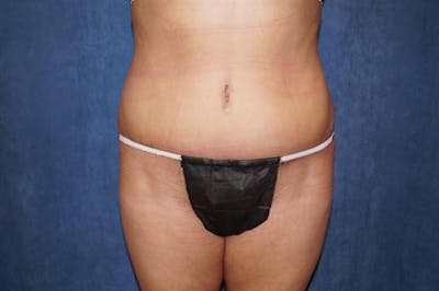 Tummy Tuck Before & After Gallery - Patient 360647 - Image 2