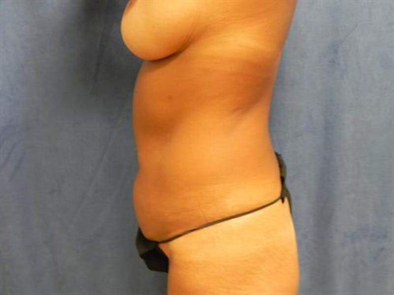 Tummy Tuck Before & After Gallery - Patient 339973 - Image 5