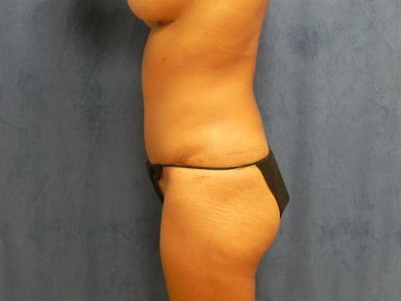 Tummy Tuck Before & After Gallery - Patient 339973 - Image 6