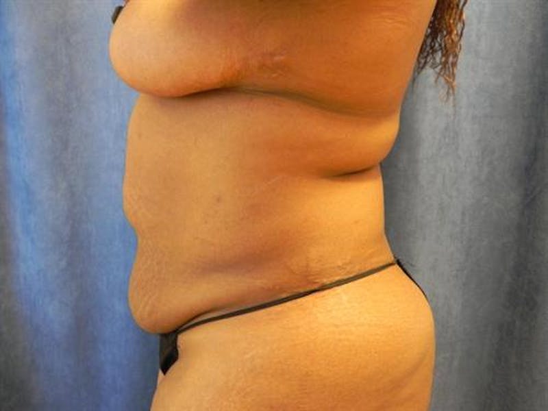 Tummy Tuck Before & After Gallery - Patient 104034 - Image 3