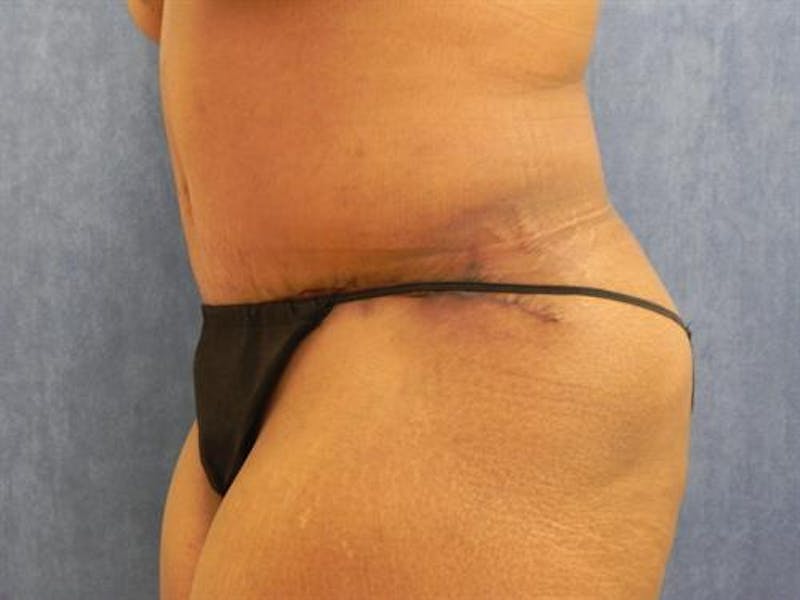 Tummy Tuck Before & After Gallery - Patient 104034 - Image 4