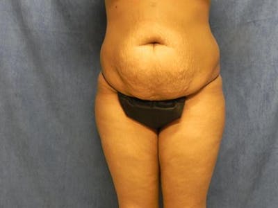 Tummy Tuck Before & After Gallery - Patient 200667 - Image 1
