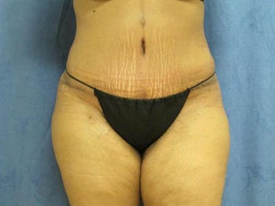 Tummy Tuck Before & After Gallery - Patient 200667 - Image 2