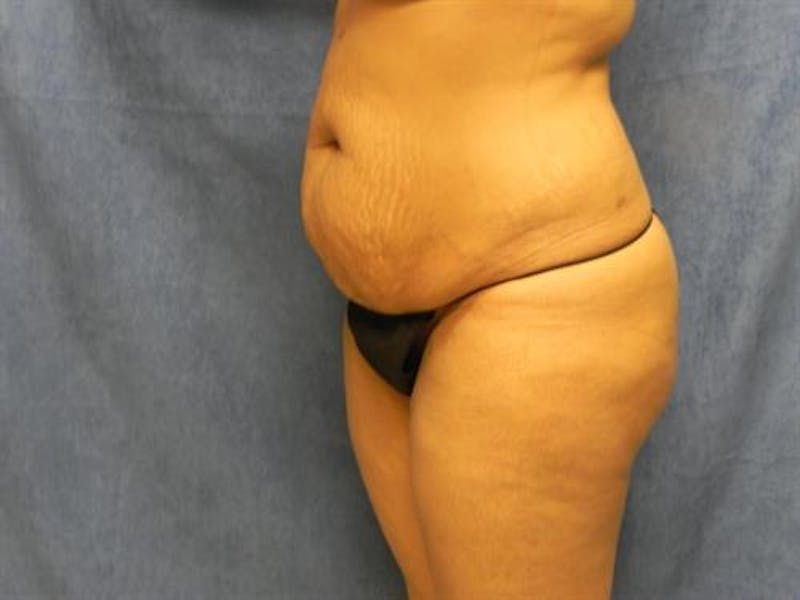 Tummy Tuck Before & After Gallery - Patient 200667 - Image 3