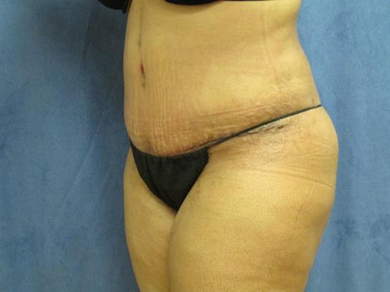 Tummy Tuck Before & After Gallery - Patient 200667 - Image 4