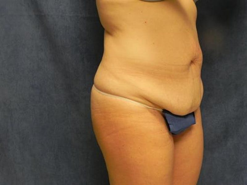 Tummy Tuck Before & After Gallery - Patient 395324 - Image 1