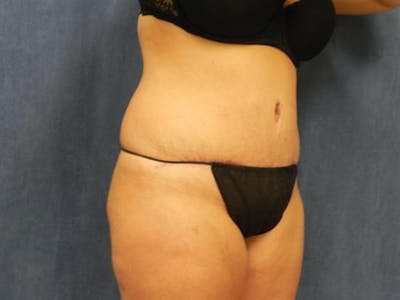Tummy Tuck Before & After Gallery - Patient 395324 - Image 2