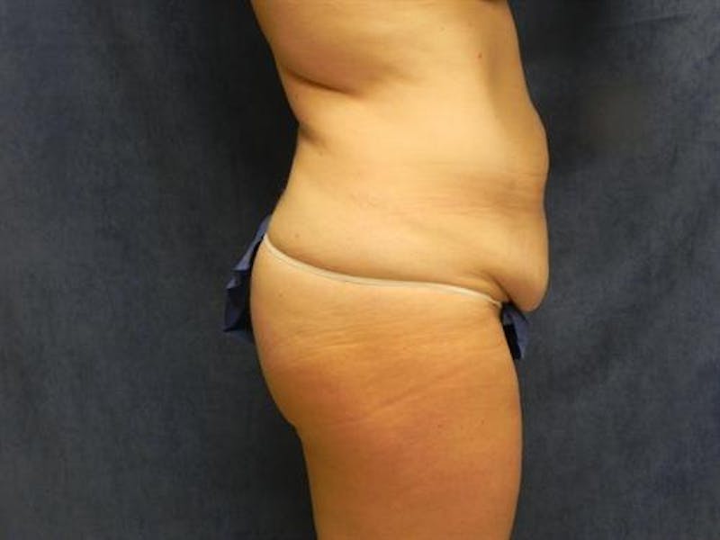 Tummy Tuck Before & After Gallery - Patient 395324 - Image 3