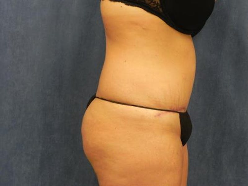 Tummy Tuck Before & After Gallery - Patient 395324 - Image 4