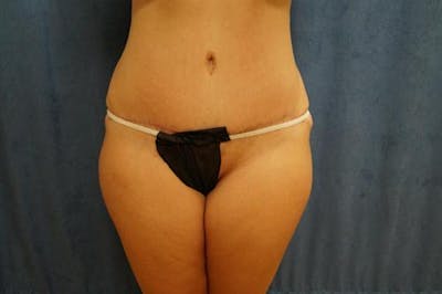 Tummy Tuck Before & After Gallery - Patient 407339 - Image 2