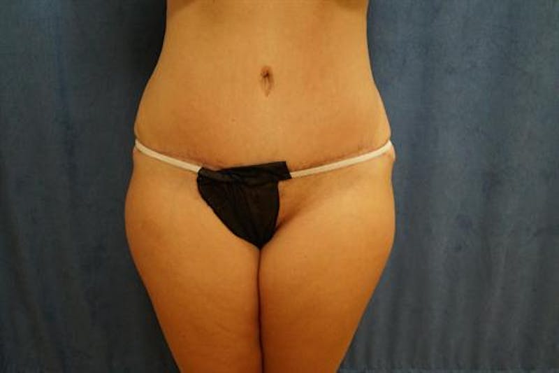 Tummy Tuck Before & After Gallery - Patient 407339 - Image 2