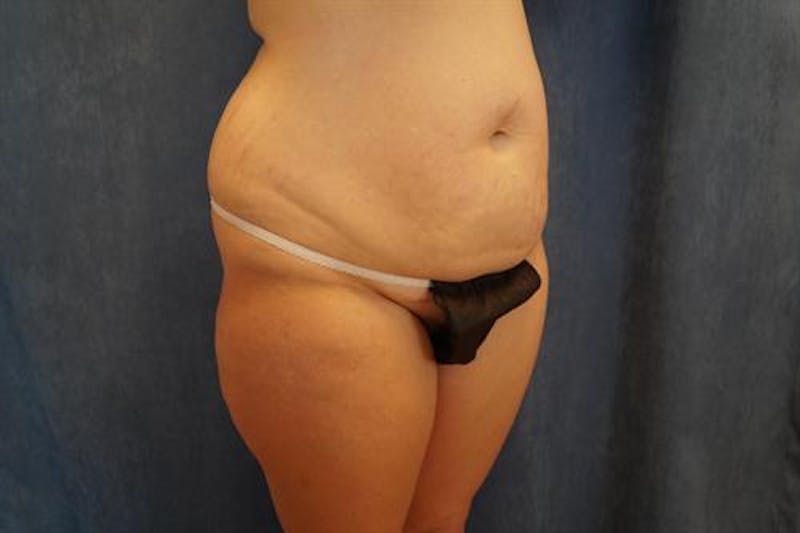 Tummy Tuck Before & After Gallery - Patient 407339 - Image 3