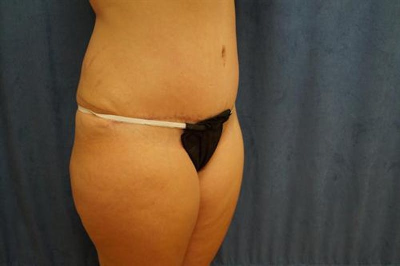 Tummy Tuck Before & After Gallery - Patient 407339 - Image 4