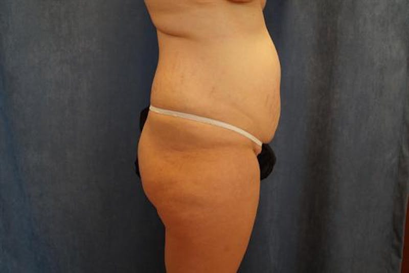 Tummy Tuck Before & After Gallery - Patient 407339 - Image 5