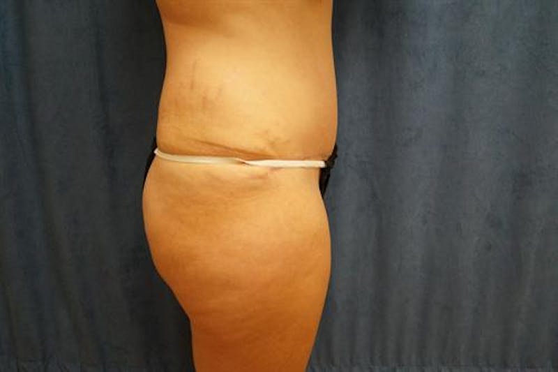Tummy Tuck Before & After Gallery - Patient 407339 - Image 6