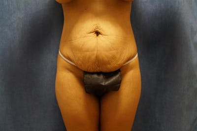 Tummy Tuck Before & After Gallery - Patient 155750 - Image 1